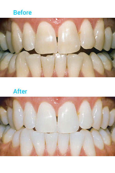 Zoom! Teeth Whitening Before and After